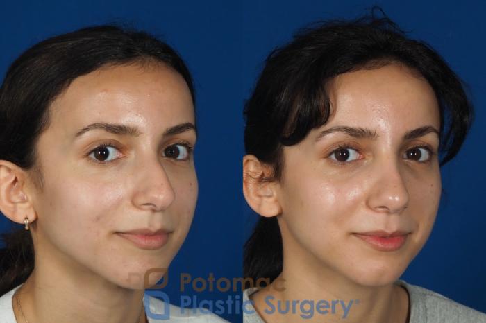 Before & After Rhinoplasty - Cosmetic Case 262 Right Oblique View #2 View in Washington DC & Arlington , DC