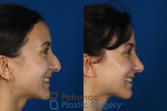 Before & After Rhinoplasty - Cosmetic Case 262 Right Side - Smiling View in Washington DC & Arlington , DC