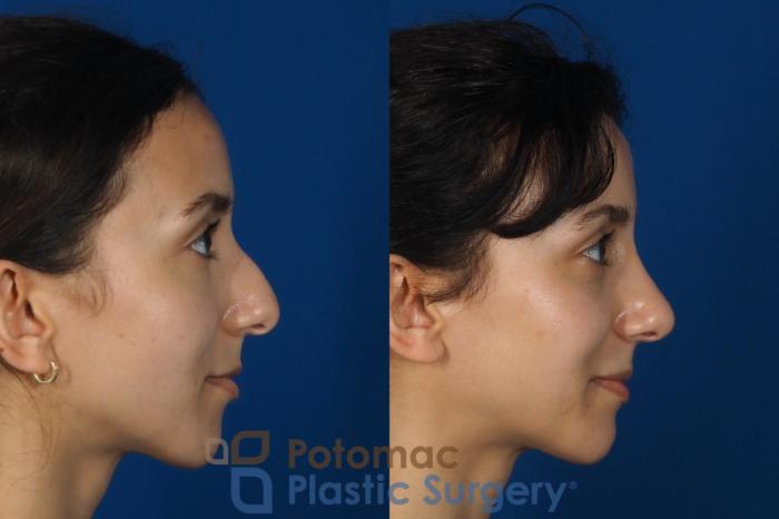 Before & After Rhinoplasty - Cosmetic Case 262 Right Side View in Washington DC & Arlington , DC