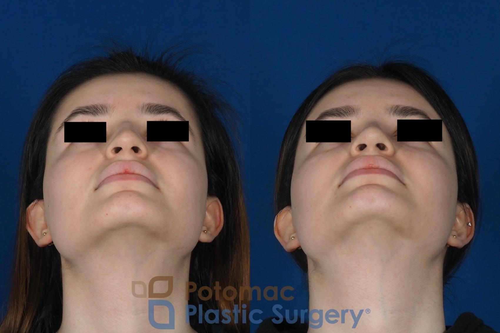 Before & After Rhinoplasty - Cosmetic Case 263 Bottom View in Washington DC & Arlington , DC