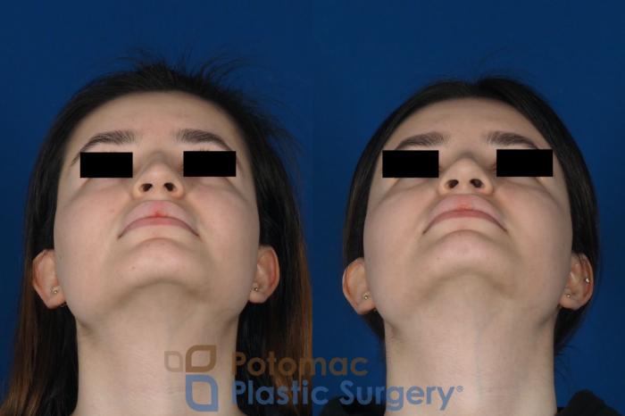 Before & After Rhinoplasty - Cosmetic Case 263 Bottom View in Washington DC & Arlington , DC