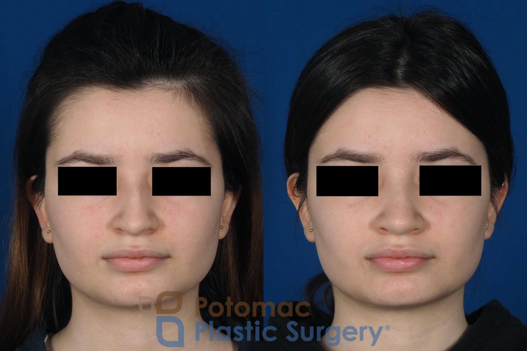 Before & After Rhinoplasty - Cosmetic Case 263 Front View in Washington DC & Arlington , DC