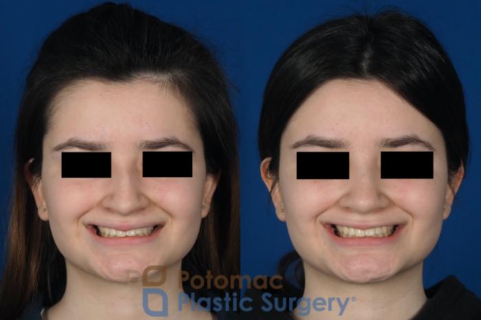 Before & After Rhinoplasty - Cosmetic Case 263 Front - Smiling View in Washington DC & Arlington , DC