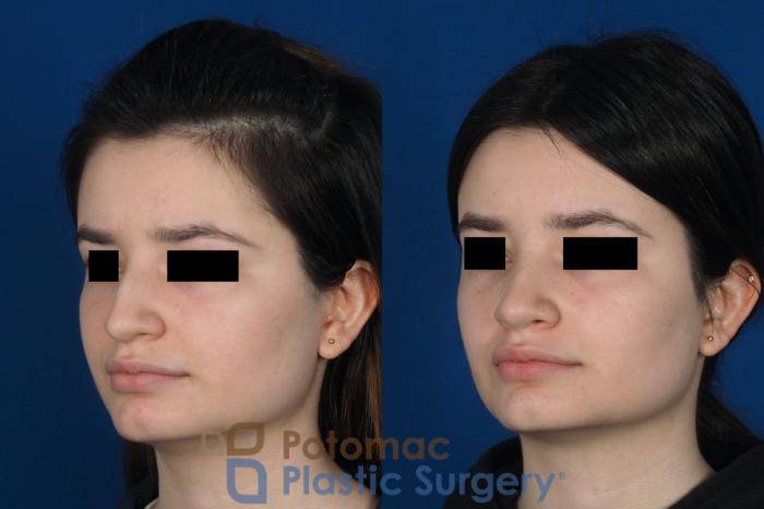Before & After Rhinoplasty - Cosmetic Case 263 Left Oblique View in Washington DC & Arlington , DC