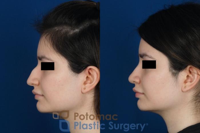 Before & After Rhinoplasty - Cosmetic Case 263 Left Side View in Washington DC & Arlington , DC