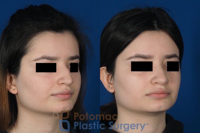 Before & After Rhinoplasty - Cosmetic Case 263 Right Oblique View in Washington DC & Arlington , DC