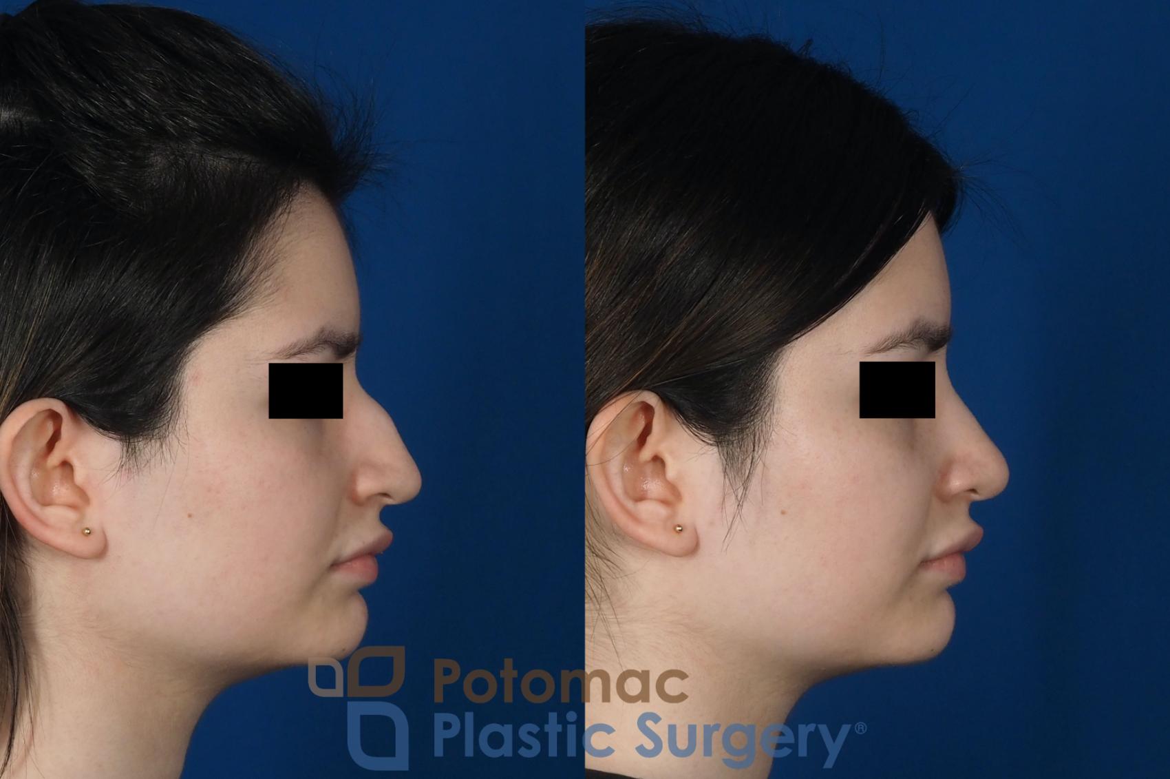 Before & After Rhinoplasty - Cosmetic Case 263 Right Side View in Washington DC & Arlington , DC