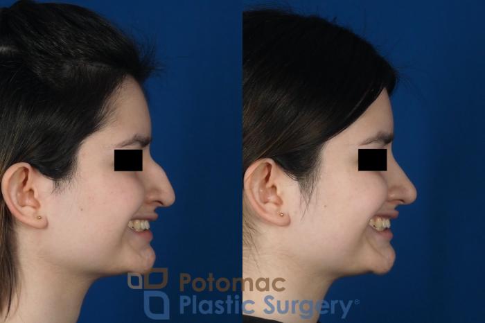 Before & After Rhinoplasty - Cosmetic Case 263 Right Side - Smiling View in Washington DC & Arlington , DC