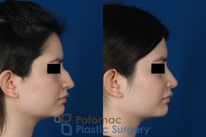 Before & After Rhinoplasty - Cosmetic Case 263 Right Side View in Washington DC & Arlington , DC