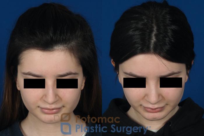 Before & After Rhinoplasty - Cosmetic Case 263 Top View in Washington DC & Arlington , DC