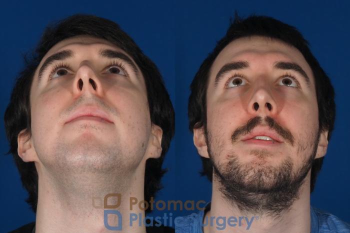 Before & After Rhinoplasty - Cosmetic Case 264 Bottom View in Washington DC & Arlington , DC