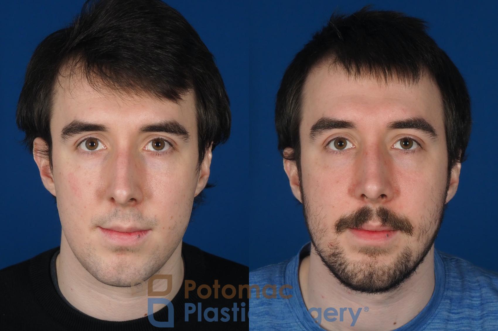 Before & After Rhinoplasty - Cosmetic Case 264 Front View in Washington, DC