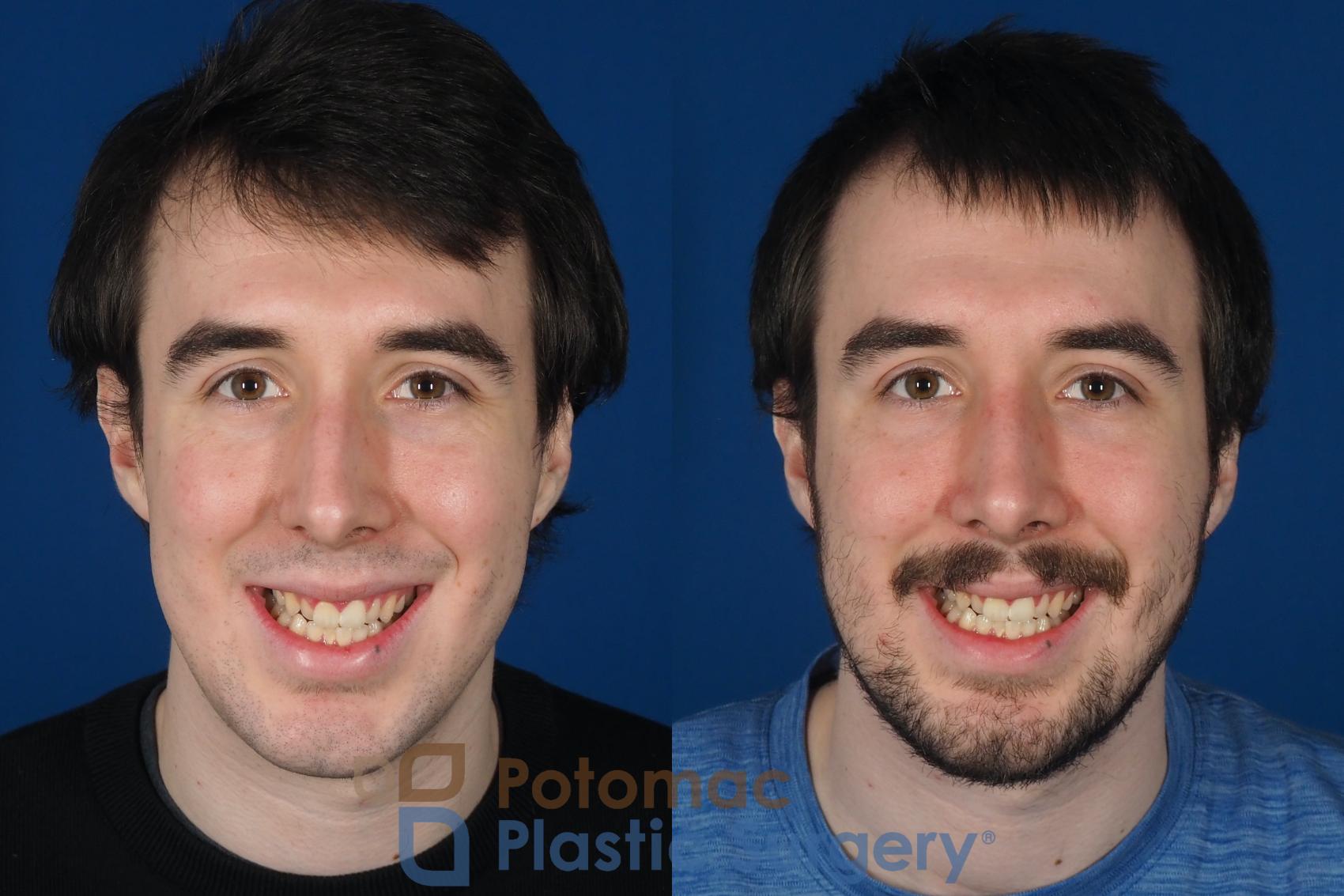 Before & After Rhinoplasty - Cosmetic Case 264 Front - Smiling View in Washington DC & Arlington , DC