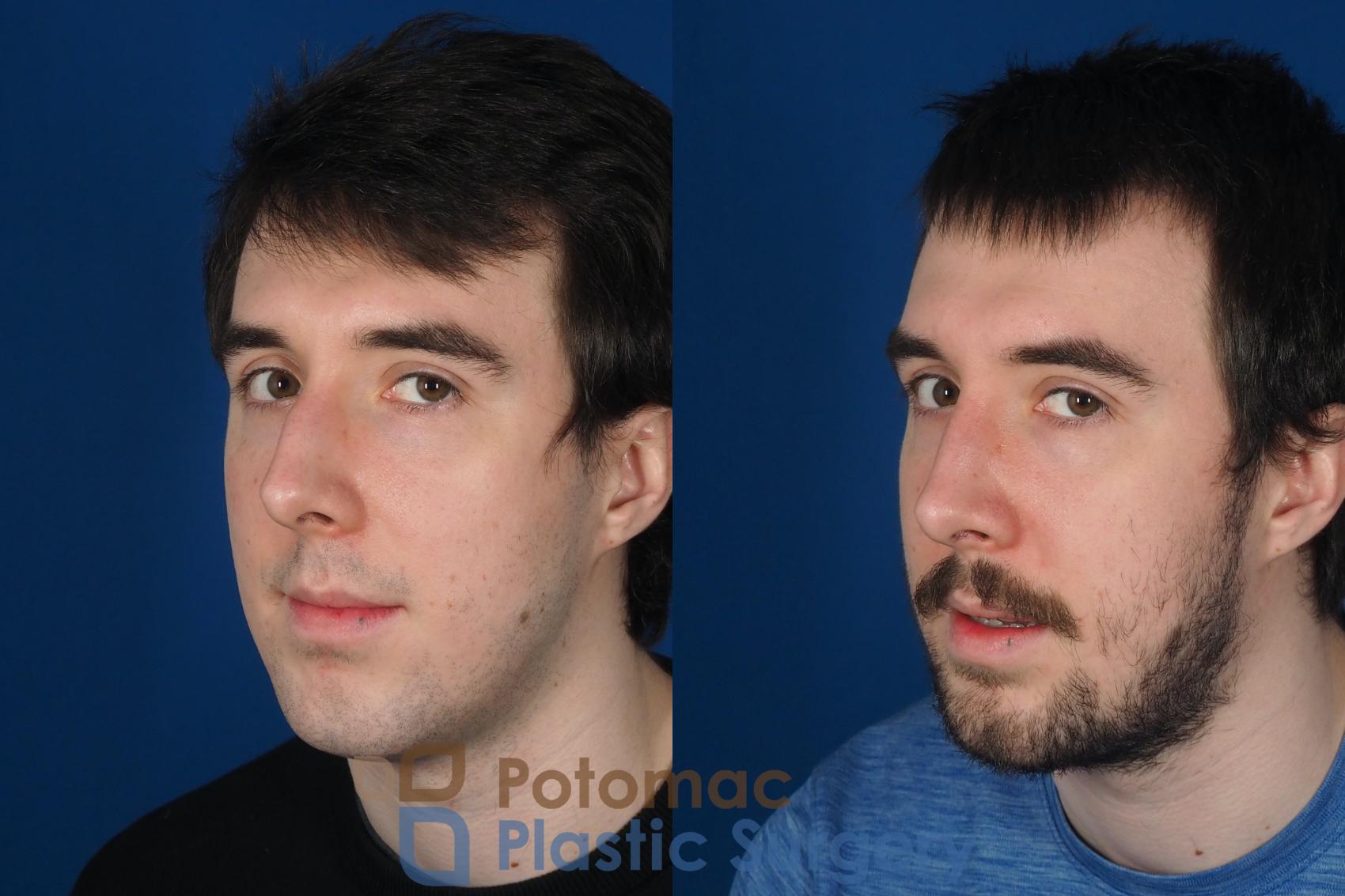 Before & After Rhinoplasty - Cosmetic Case 264 Left Oblique View #2 View in Washington DC & Arlington , DC