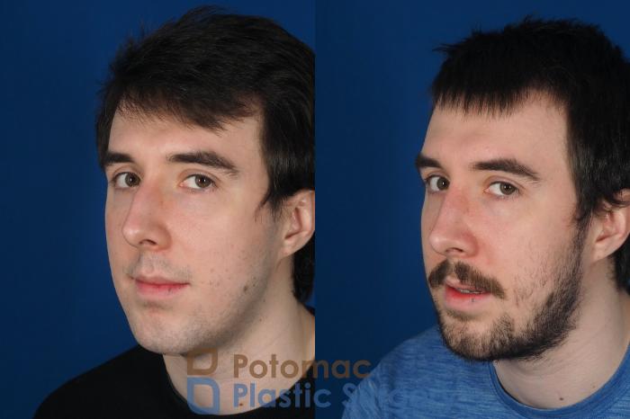 Before & After Rhinoplasty - Medical Case 264 Left Oblique View #2 View in Washington DC & Arlington , DC