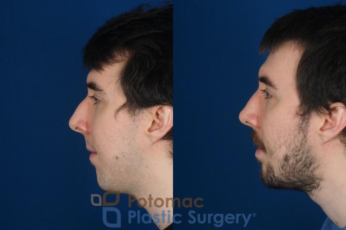 Before & After Rhinoplasty - Cosmetic Case 264 Left Side View in Washington DC & Arlington , DC
