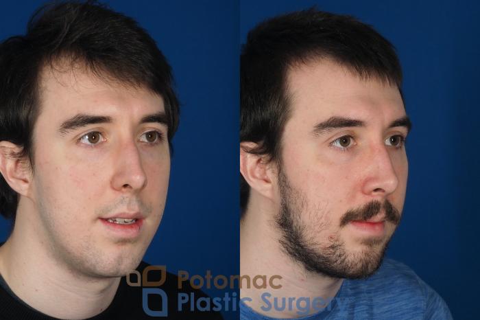 Before & After Rhinoplasty - Cosmetic Case 264 Right Oblique View in Washington DC & Arlington , DC