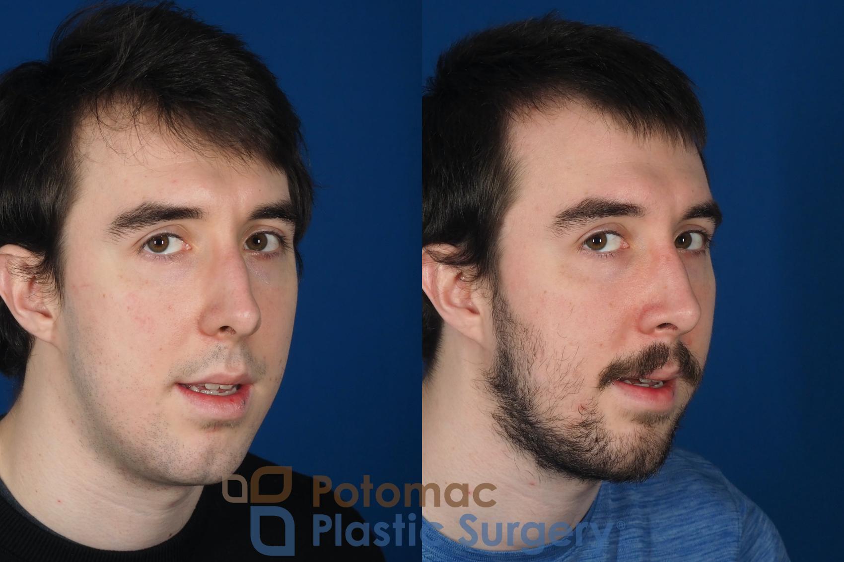 Before & After Rhinoplasty - Cosmetic Case 264 Right Oblique View #2 View in Washington DC & Arlington , DC