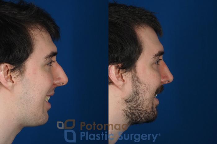 Before & After Rhinoplasty - Cosmetic Case 264 Right Side Smile View in Washington DC & Arlington , DC