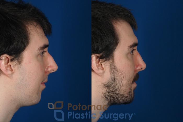 Before & After Rhinoplasty - Medical Case 264 Right Side View in Washington DC & Arlington , DC