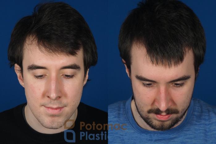 Before & After Rhinoplasty - Medical Case 264 Top View in Washington DC & Arlington , DC