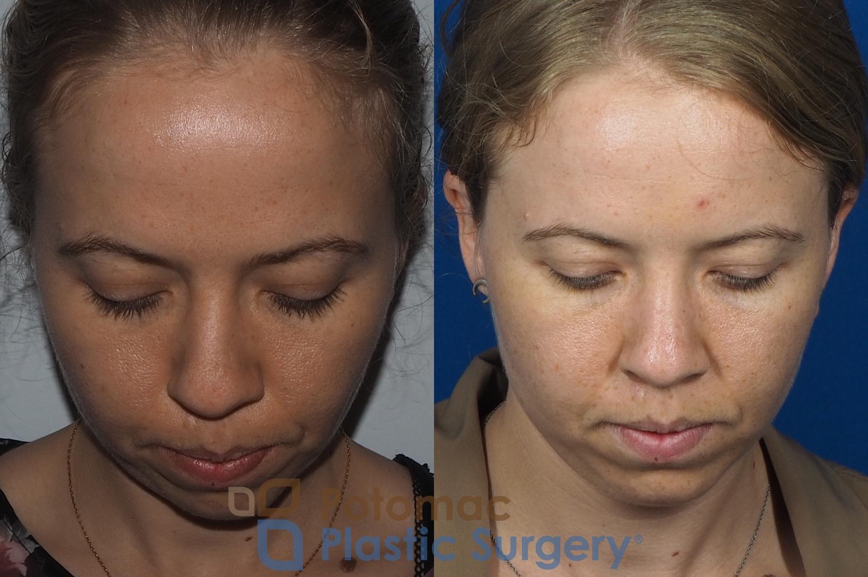 Before & After Rhinoplasty - Cosmetic Case 267 Above View in Washington DC & Arlington , DC