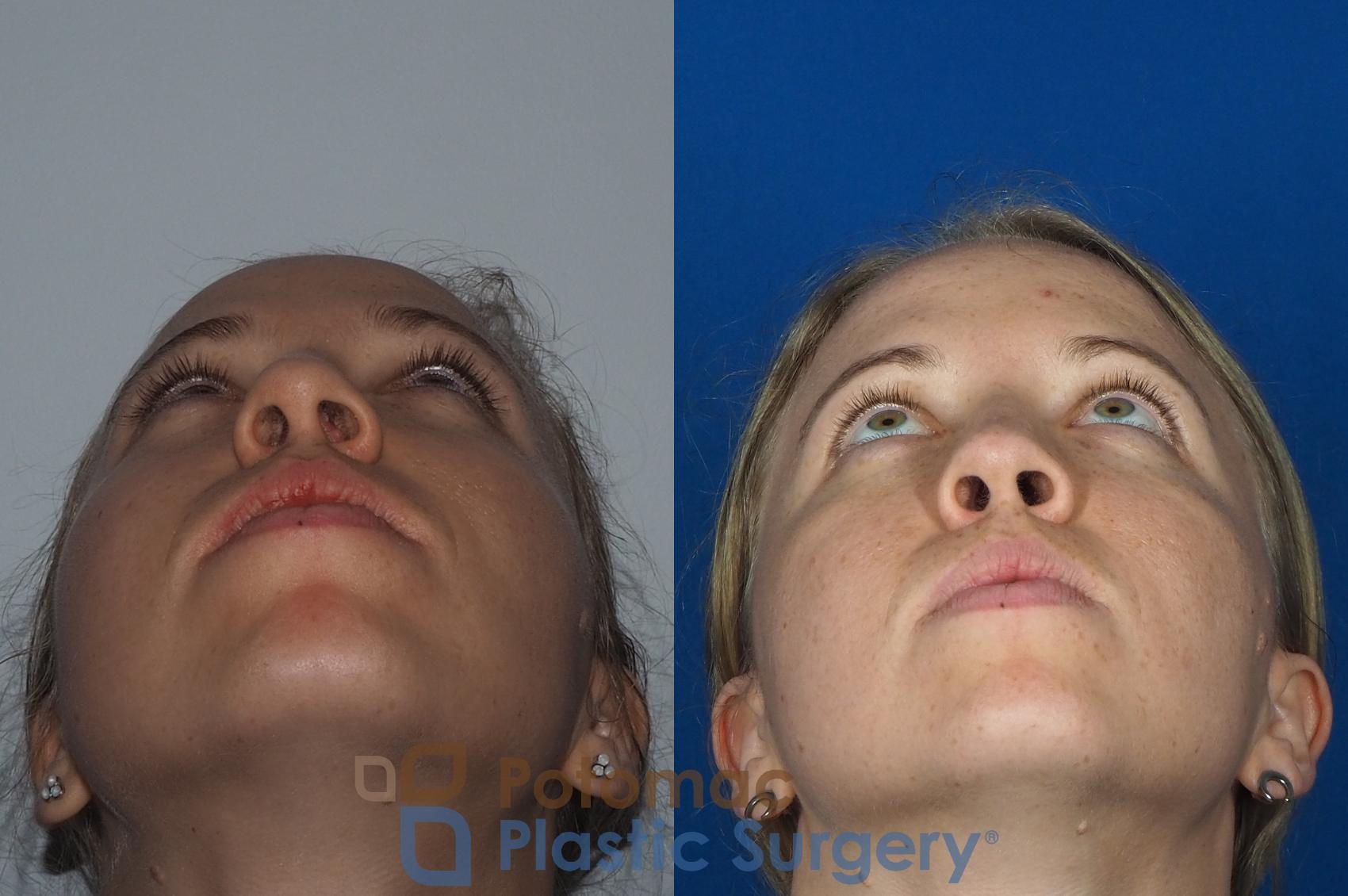 Before & After Rhinoplasty - Cosmetic Case 267 Below View in Washington DC & Arlington , DC