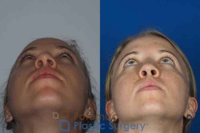 Before & After Rhinoplasty - Medical Case 267 Below View in Washington DC & Arlington , DC