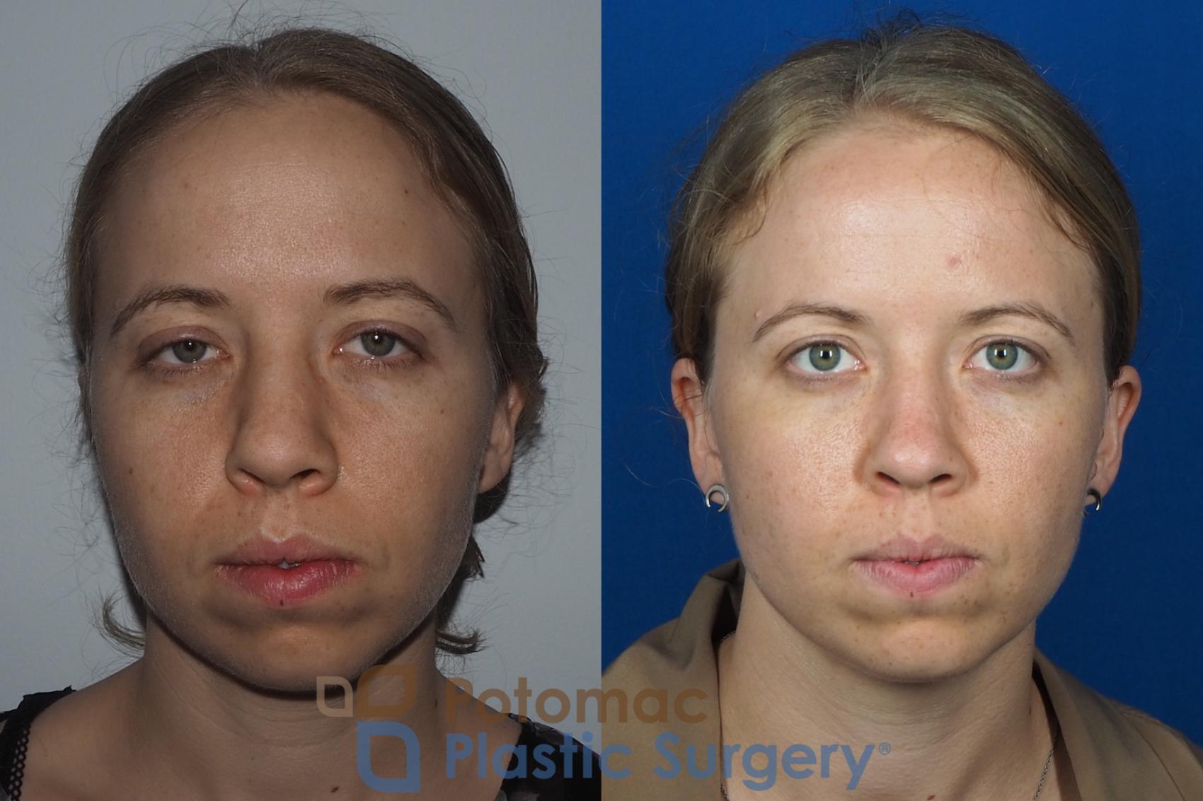Before & After Rhinoplasty - Medical Case 267 Front View #1 View in Washington DC & Arlington , DC