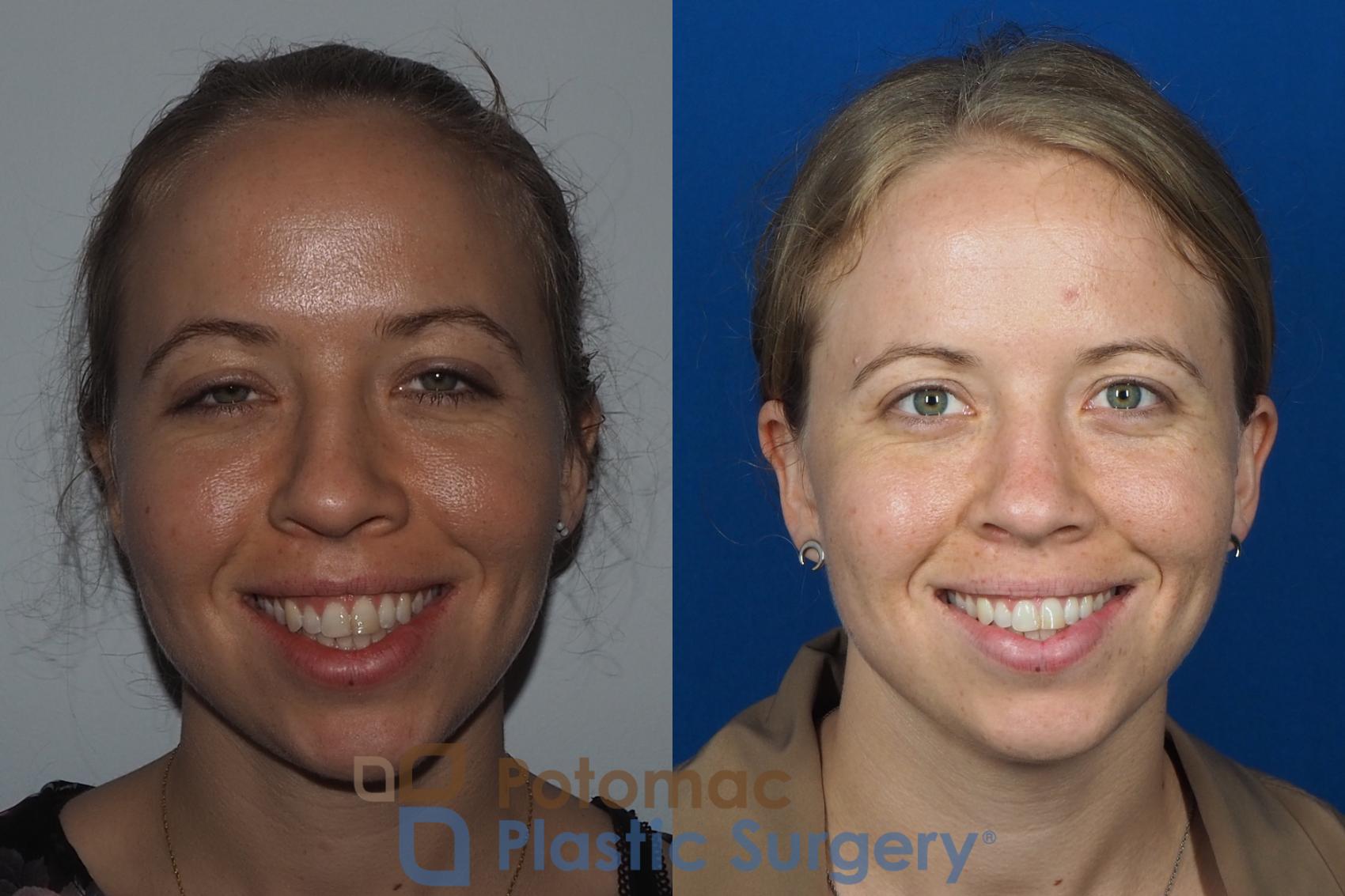 Before & After Rhinoplasty - Cosmetic Case 267 Front View #2 View in Washington DC & Arlington , DC