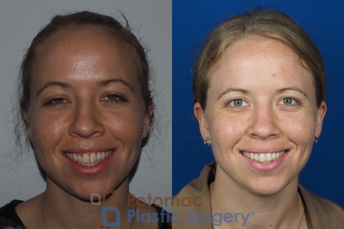 Before & After Rhinoplasty - Medical Case 267 Front View #2 View in Washington DC & Arlington , DC