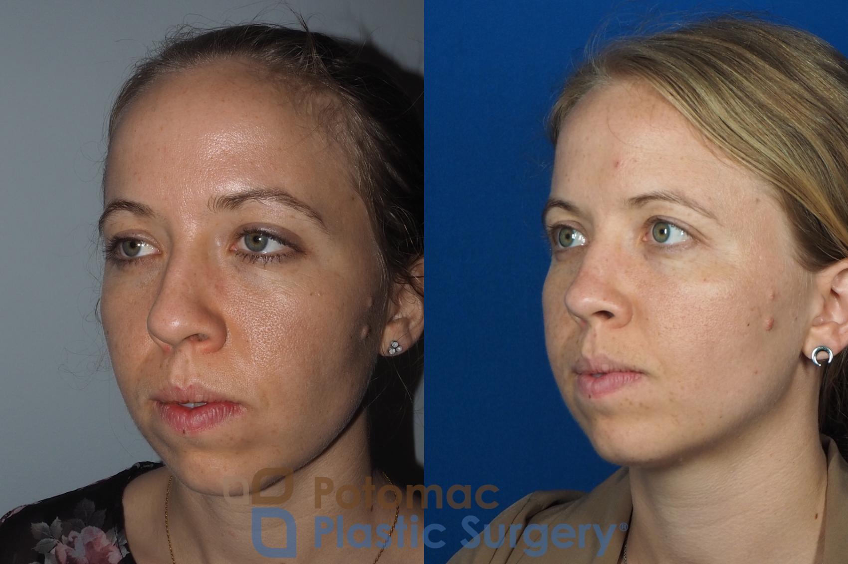 Before & After Rhinoplasty - Cosmetic Case 267 Left Oblique View in Washington DC & Arlington , DC