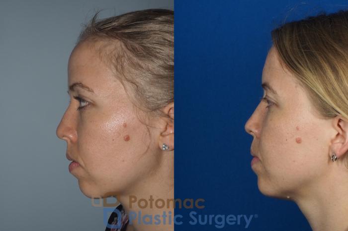 Before & After Rhinoplasty - Cosmetic Case 267 Left Side View in Arlington, VA & Washington, DC