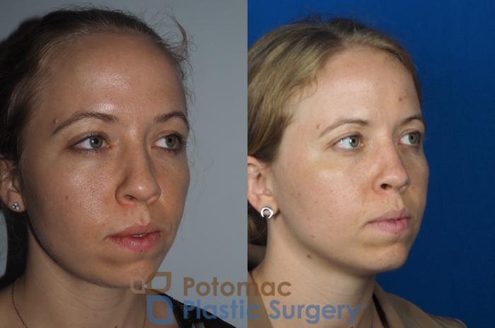 Before & After Rhinoplasty - Cosmetic Case 267 Right Oblique View in Arlington, VA & Washington, DC