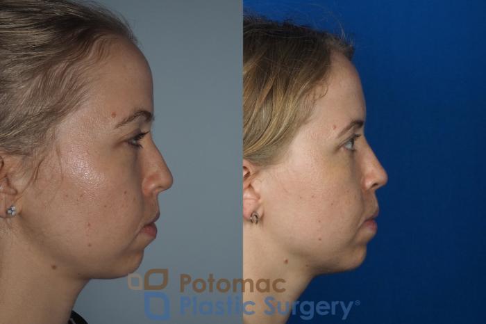 Before & After Rhinoplasty - Cosmetic Case 267 Right Side View in Arlington, VA & Washington, DC