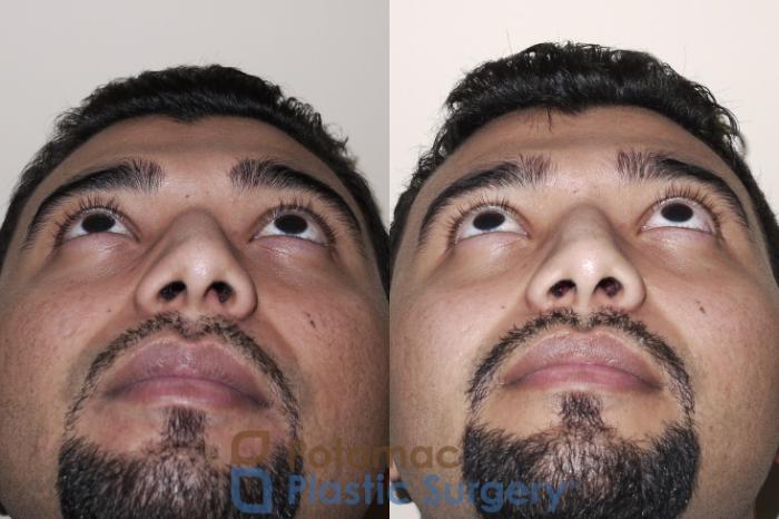 Before & After Rhinoplasty - Cosmetic Case 27 Bottom View in Washington DC & Arlington , DC