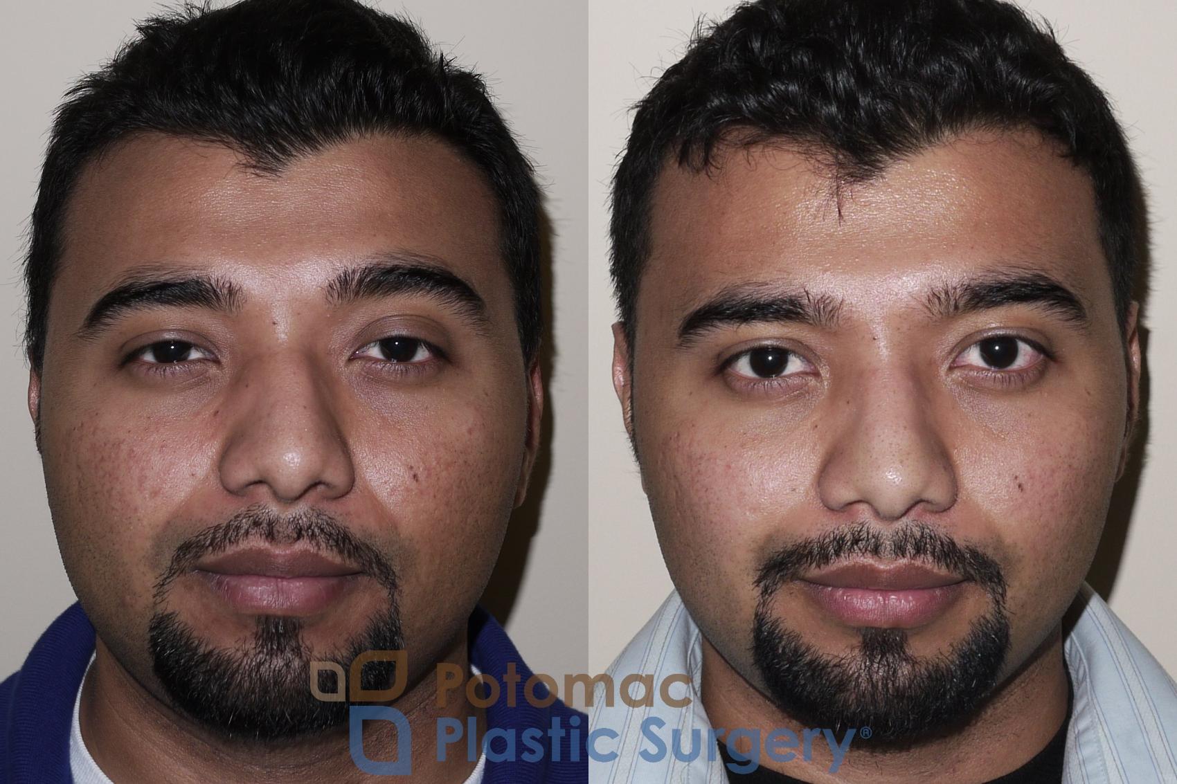 Before & After Rhinoplasty - Cosmetic Case 27 Front View in Washington DC & Arlington , DC