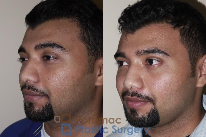 Before & After Rhinoplasty - Cosmetic Case 27 Left Oblique View in Washington DC & Arlington , DC