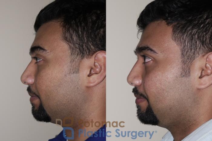 Before & After Rhinoplasty - Cosmetic Case 27 Left Side View in Washington DC & Arlington , DC