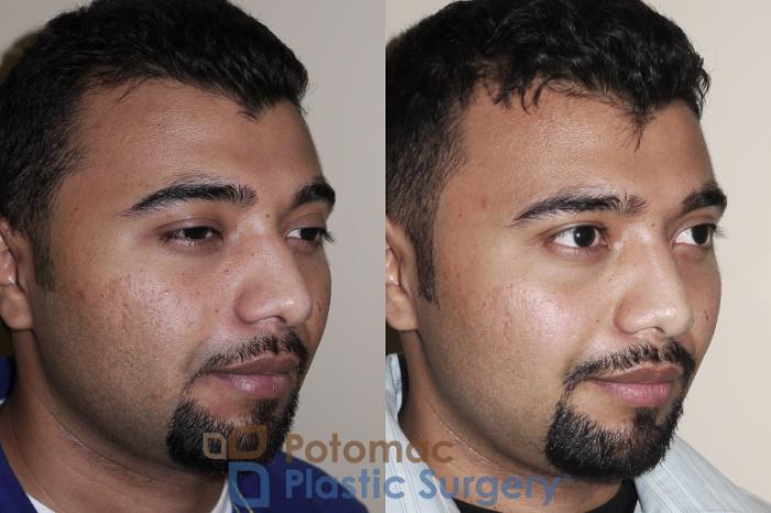 Before & After Rhinoplasty - Cosmetic Case 27 Right Oblique View in Washington DC & Arlington , DC