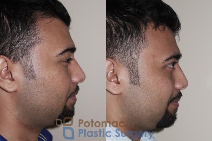 Before & After Rhinoplasty - Cosmetic Case 27 Right Side View in Washington DC & Arlington , DC