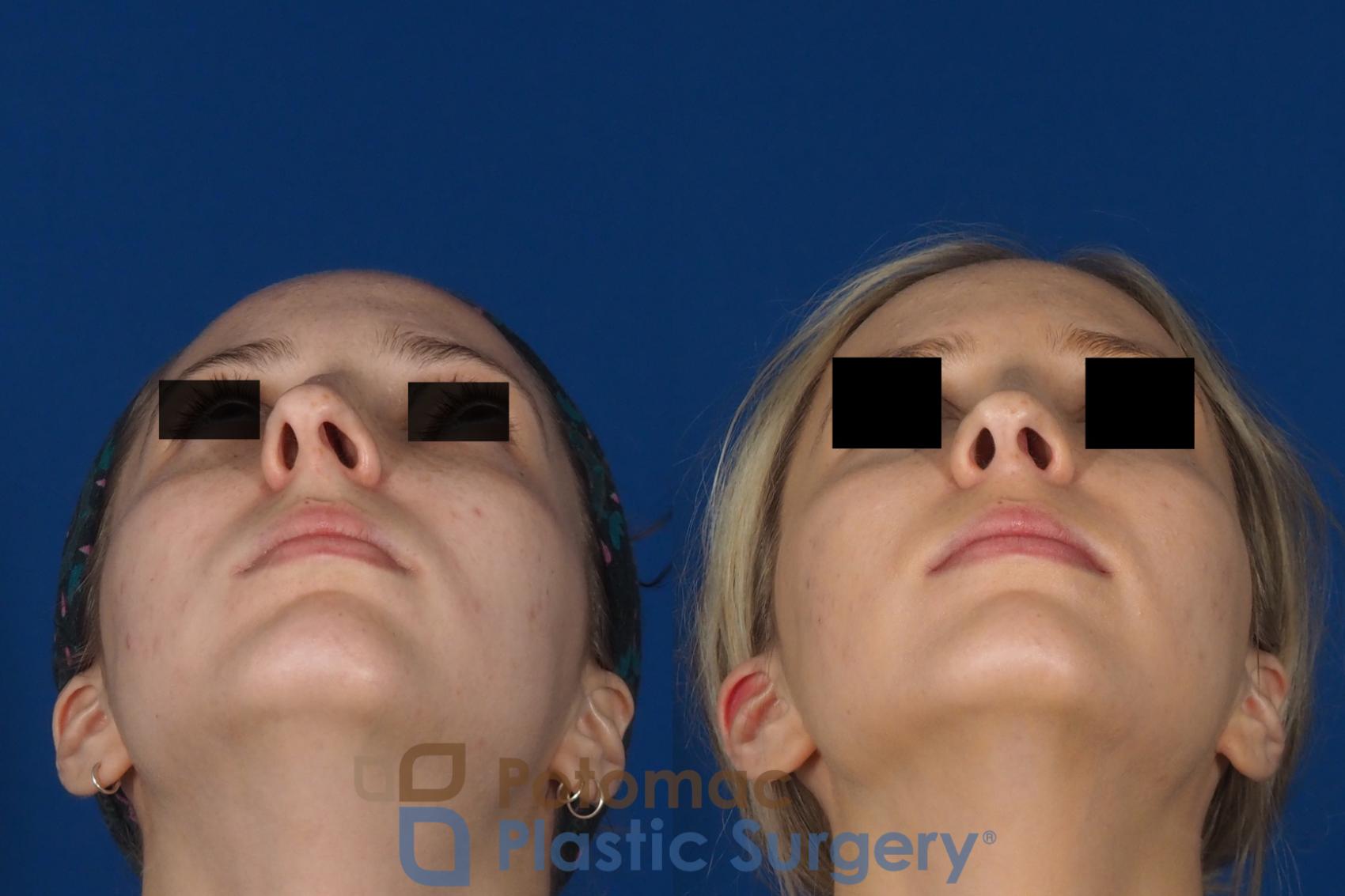 Before & After Rhinoplasty - Cosmetic Case 270 Bottom View in Washington DC & Arlington , DC