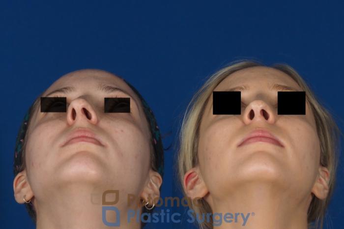Before & After Rhinoplasty - Cosmetic Case 270 Bottom View in Washington DC & Arlington , DC