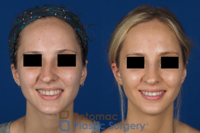 Before & After Rhinoplasty - Cosmetic Case 270 Front - Smiling View in Washington DC & Arlington , DC