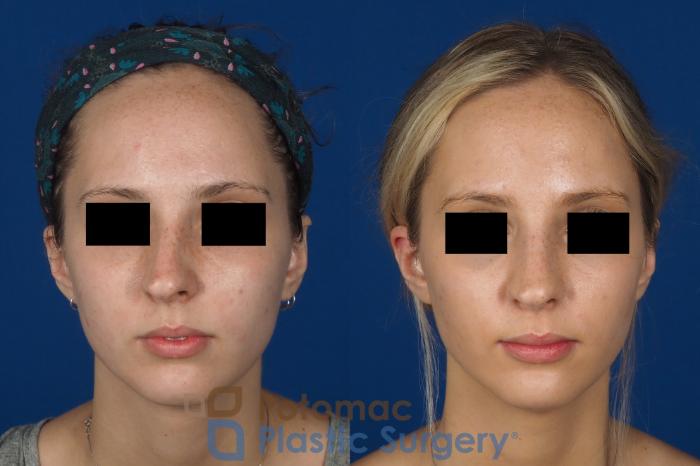 Before & After Rhinoplasty - Medical Case 270 Front View in Washington DC & Arlington , DC
