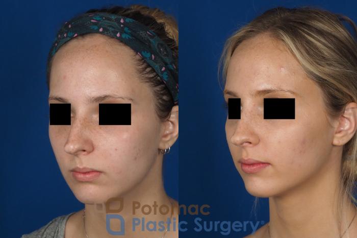 Before & After Rhinoplasty - Medical Case 270 Left Oblique View in Washington DC & Arlington , DC