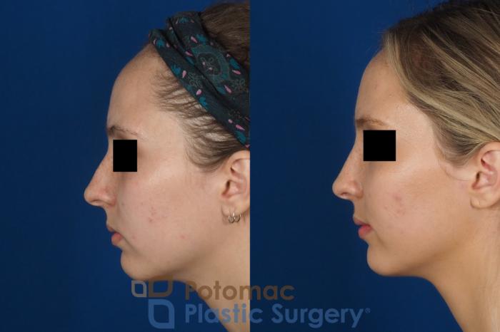 Before & After Rhinoplasty - Medical Case 270 Left Side View in Washington DC & Arlington , DC
