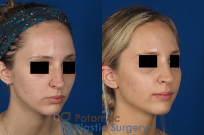 Before & After Rhinoplasty - Medical Case 270 Right Oblique View in Washington DC & Arlington , DC