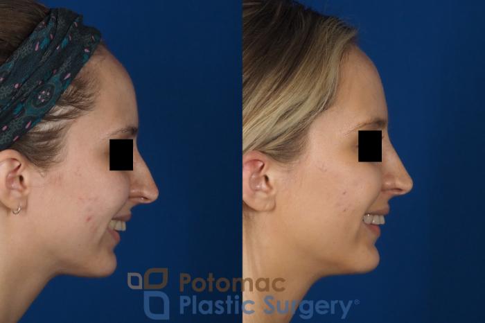 Before & After Rhinoplasty - Cosmetic Case 270 Right Side - Smiling View in Washington DC & Arlington , DC