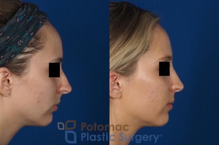 Before & After Rhinoplasty - Cosmetic Case 270 Right Side View in Washington DC & Arlington , DC